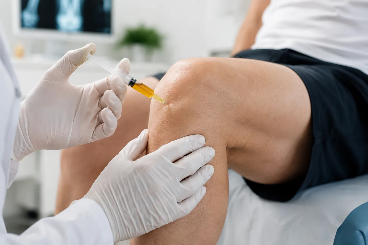 PRP injekcijos į kelį: ar jos padeda sergant osteoartritu?